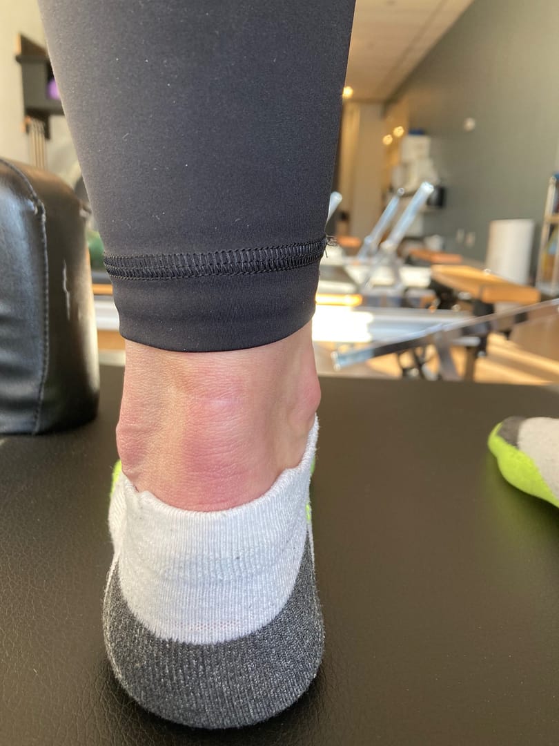 Photo of surgically repaired L achilles Photo of surgically repaired L achilles