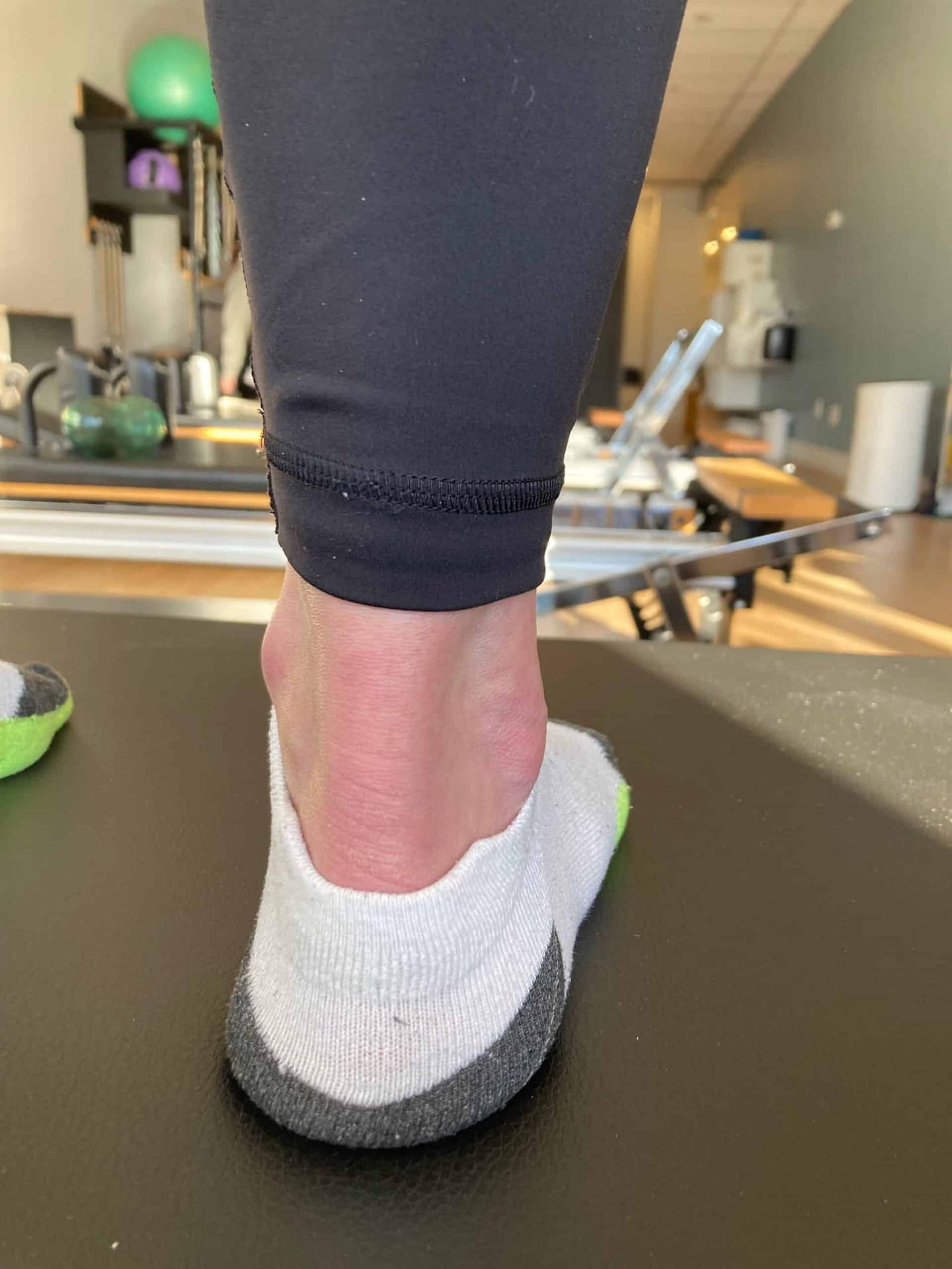 achilles recovery non surgical Picture of achilles tendon with non surgical repair.